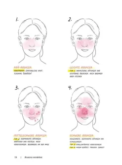 Rosacea*Trias Best
